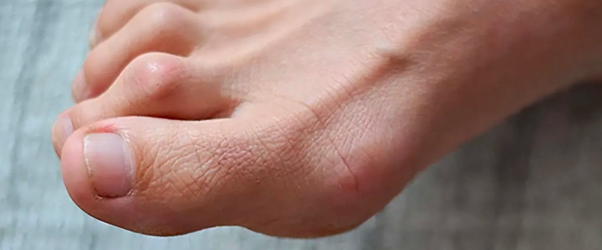 Is It Nerve Damage? Discover the Causes of Claw Toe Deformity