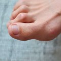 Is It Nerve Damage? Discover the Causes of Claw Toe Deformity