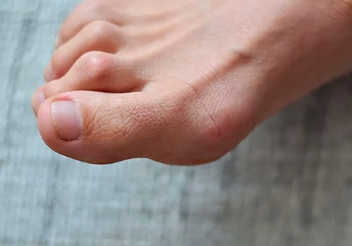 Is It Nerve Damage? Discover the Causes of Claw Toe Deformity